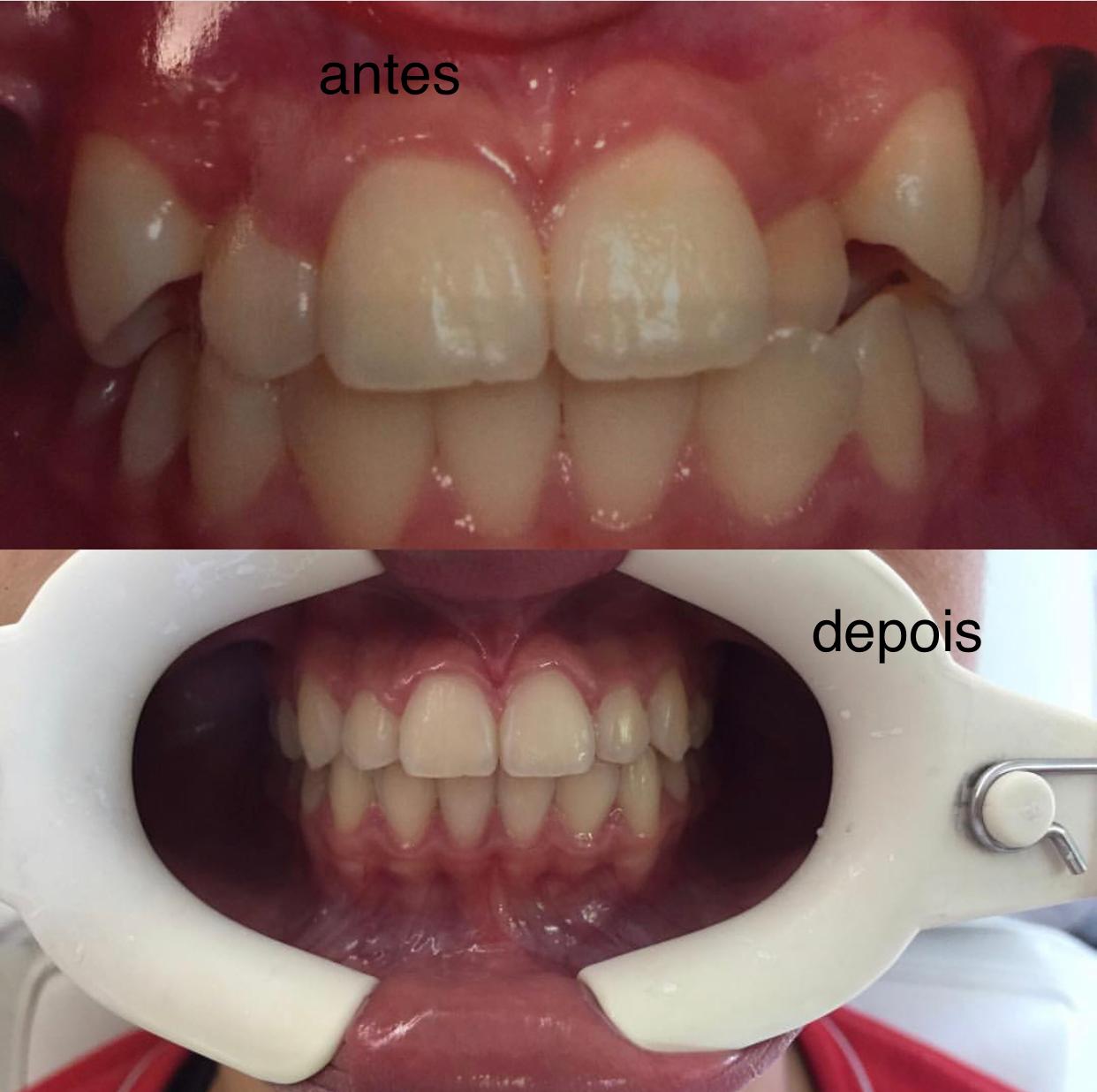 16.06.2019 antes e depois ortodontia.2 jpg