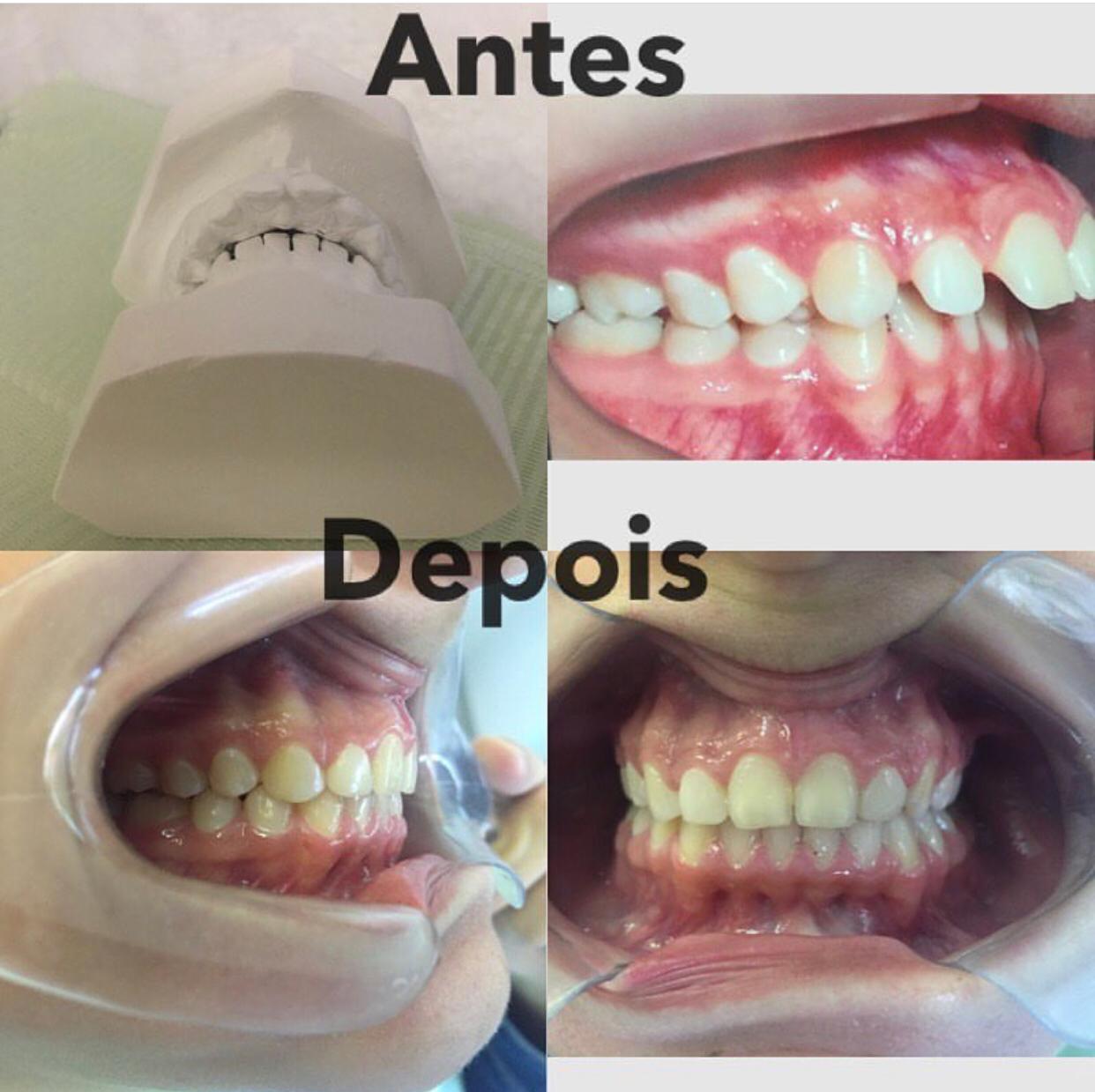 16.06.2019 antes e depois ortodontia